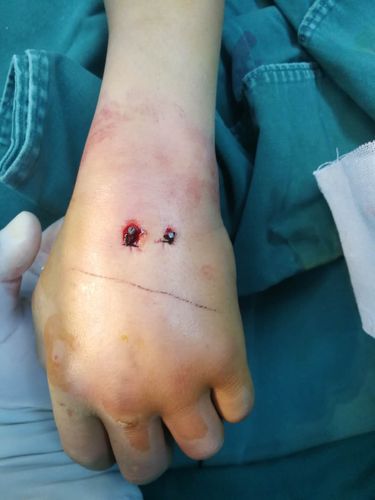 掌骨骨折闭合复位克氏针内固定