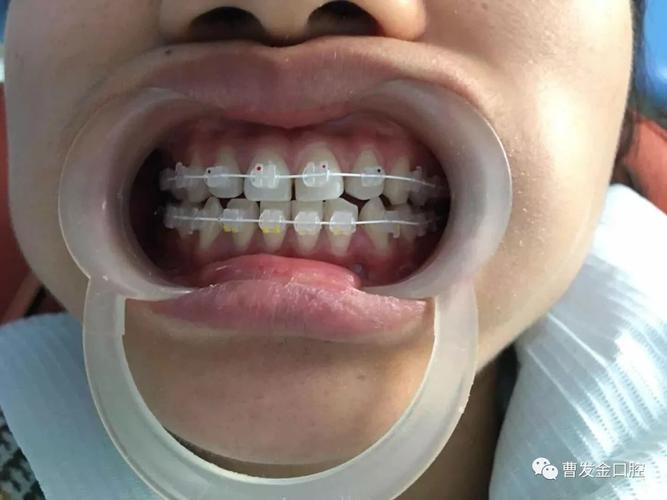 陶瓷托槽正畸