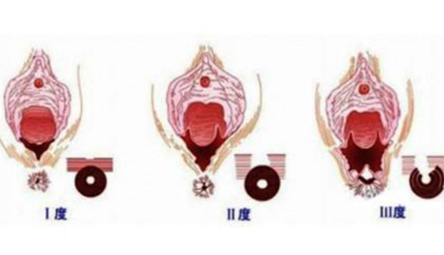 会阴撕裂缝针流血的图片
