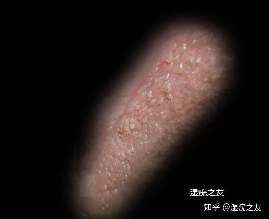 怎样区分尖锐湿疣与假性湿疣?