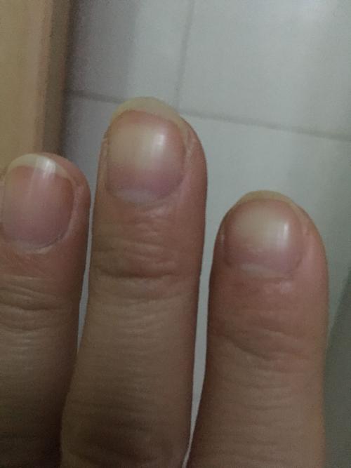 指甲中间怎么是白色的