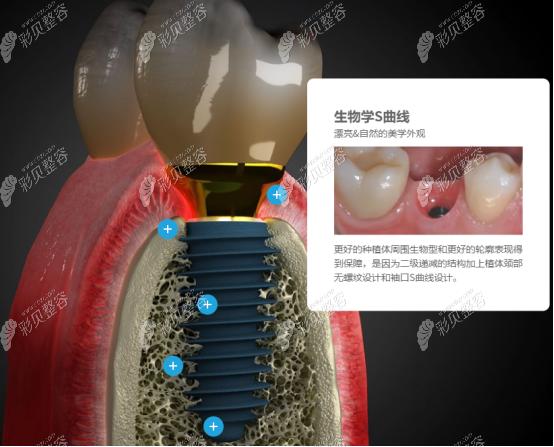 韩国美格真种植体多少钱结合优点以及产品型号为你解析