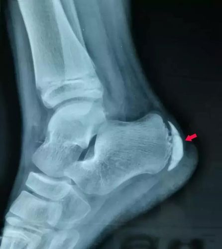 儿童运动过度的骨骺炎