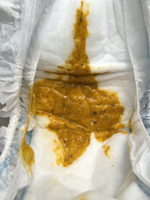 早上宝宝拉粑粑的颜色,会是和吃了八宝惊风散有关吗?有宝妈知道吗?