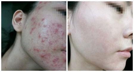祛痘对比照片大图_百度图片搜索