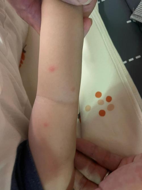 宝宝身上长的莫名红疹