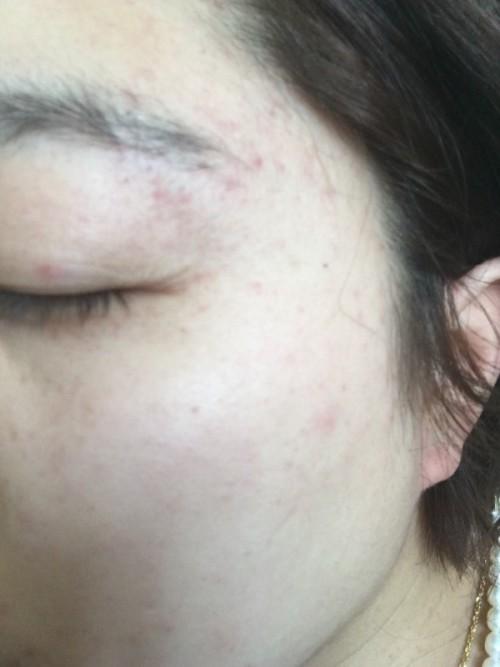 一觉起来眼睛周围长了好多小红点,不疼不痒,也摸不到