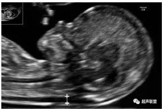 nt测量的标准切面(宝宝的大头照)