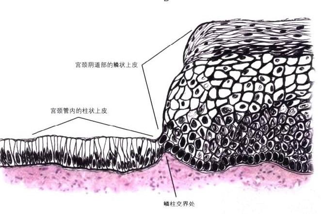 子宫颈是如何固定在盆腔的呢,主要是由8条韧带来固定(俗称八台大轿).