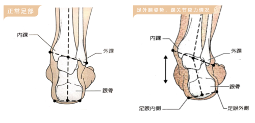 通俗来讲,从后面观察个案的足跟部,发现跟骨偏离中线,朝向足外侧移动
