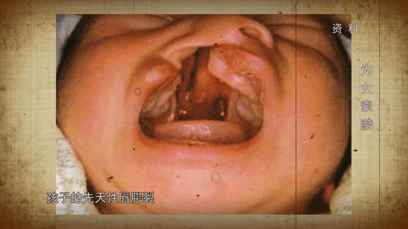 法治天下 | 喜得千金,竟发现孩子患有先天唇腭裂