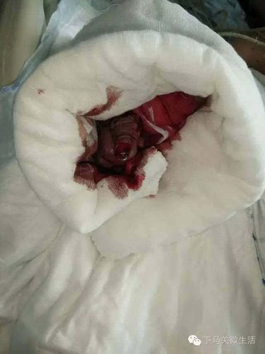 [后续]海原贾塘7岁男童断肢离体时间过久 已进行截肢手术 目前状况