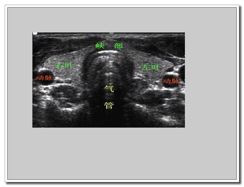 甲状腺超声报告怎么看?