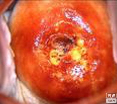 宫颈癌患者能活多久