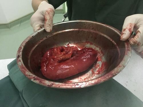 孙贵才胃癌手术部分照片(副本)