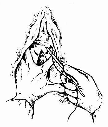 顺产生孩子侧切伤口全过程