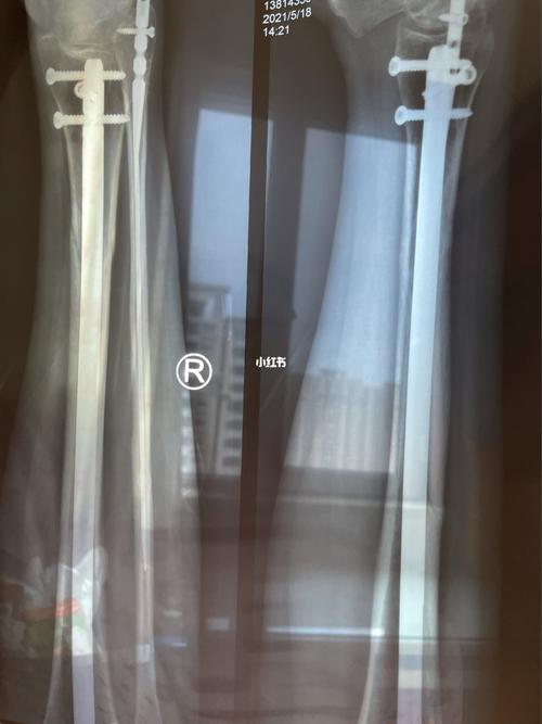 胫腓骨骨折100天_医疗健康_医疗健康其他