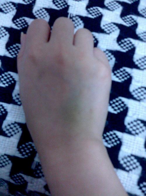 挂完吊瓶手一直发青怎么回事