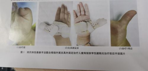 儿童狭窄性腱鞘炎
