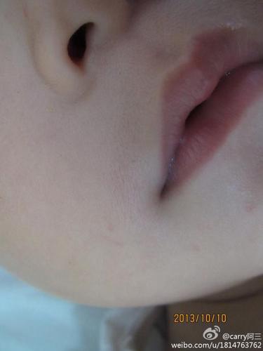 你好我家男宝快2岁嘴部最近长黑色胡须了背部手上也都