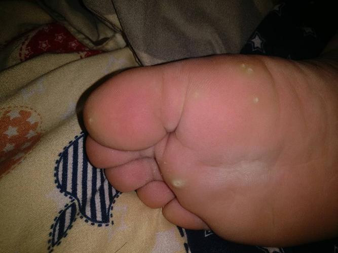 这是鸡眼还是趾疣,我该怎么治疗,中间有个坑