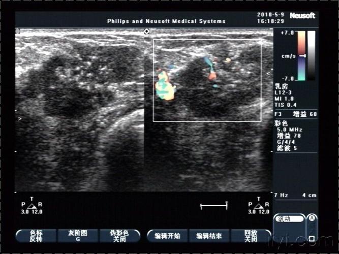 乳腺癌典型声像图 - 超声医学讨论版 - 爱爱医医学论坛