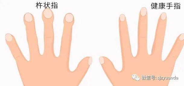 杵状指是指手指或脚趾末端增生,肥厚,增宽,增厚,远端指节从根部到