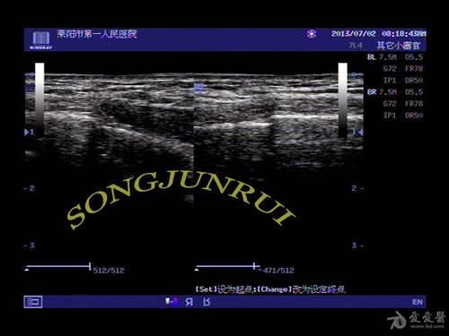 超声入门贴111-----肌骨超声典型病例--肋骨骨折超声图
