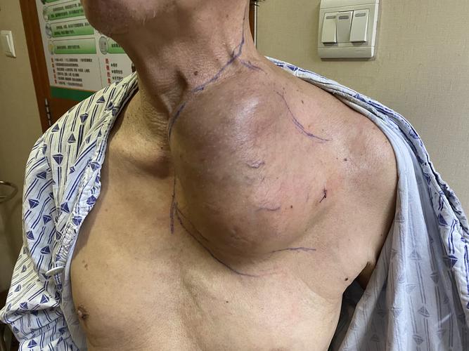 活检病理考虑梭形细胞恶性肿瘤,累及左侧胸锁关节,胸骨柄,第1-3前肋
