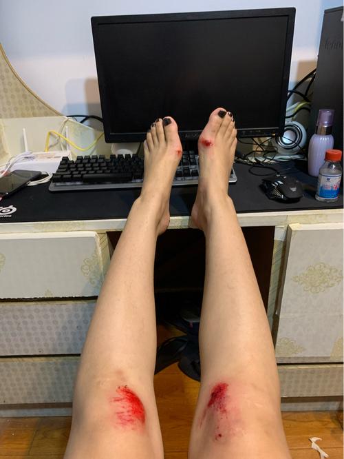 摔伤_医疗健康_医疗健康其他