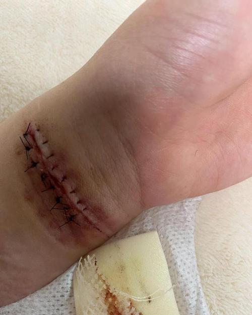 被送到医院后检查神经线断了,都无法麻醉,所以经历缝针的痛苦后加了