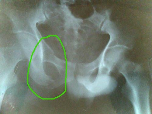 右骨盆坐骨和趾骨骨折能评定上残疾吗?