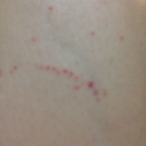 白血病出血点图片