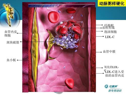 医学 立普妥课件ppt 动脉粥样硬化 血管内皮 细胞 斑块破裂 纤维帽