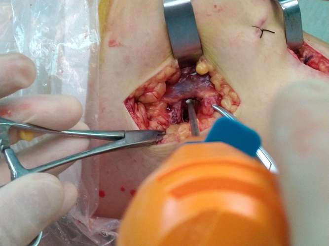 前交叉韧带内侧副韧带断裂外侧半月板撕裂关节镜微创治疗.