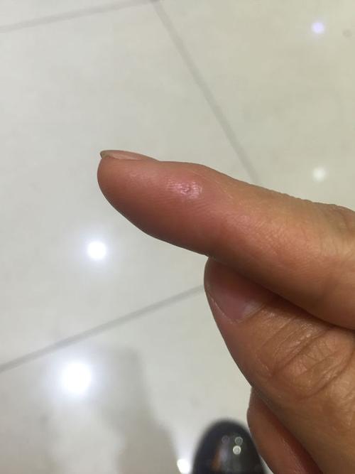 我的手上长了一个疙瘩不知道是鸡眼还是疣,求指点啊,高分酬谢,大家