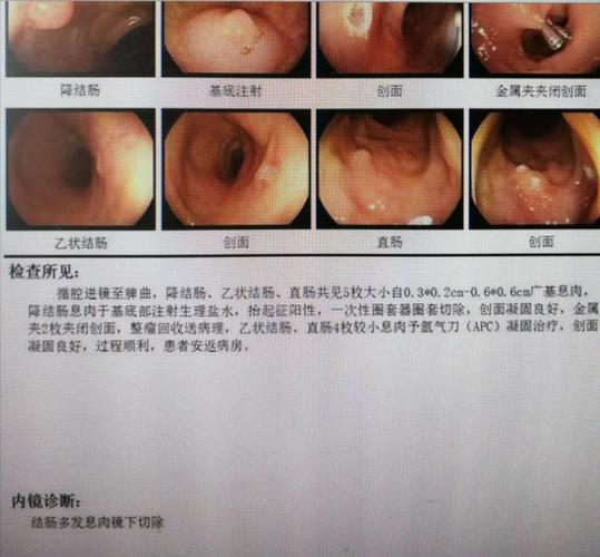 结肠息肉镜下切除1例