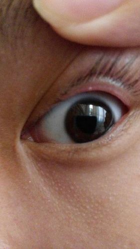 眼皮内长这些是什么来的,透明的,像水泡,时不时会出现