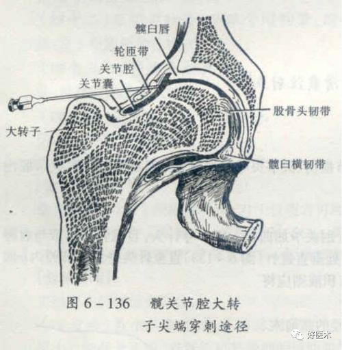 常用关节腔穿刺方法技巧大全都在这里了