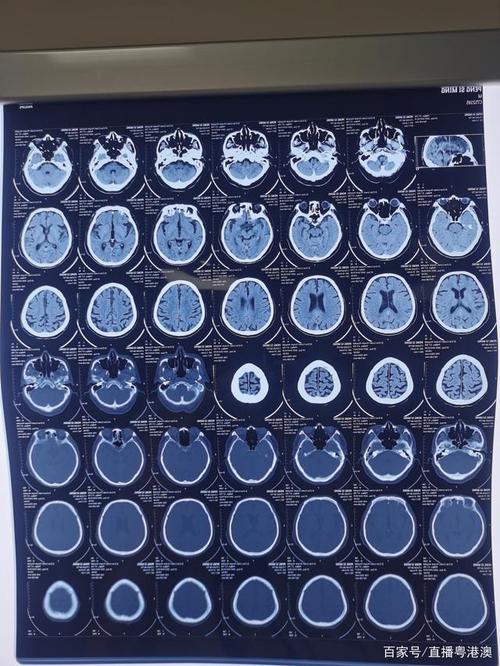 小美手术前脑部ct片
