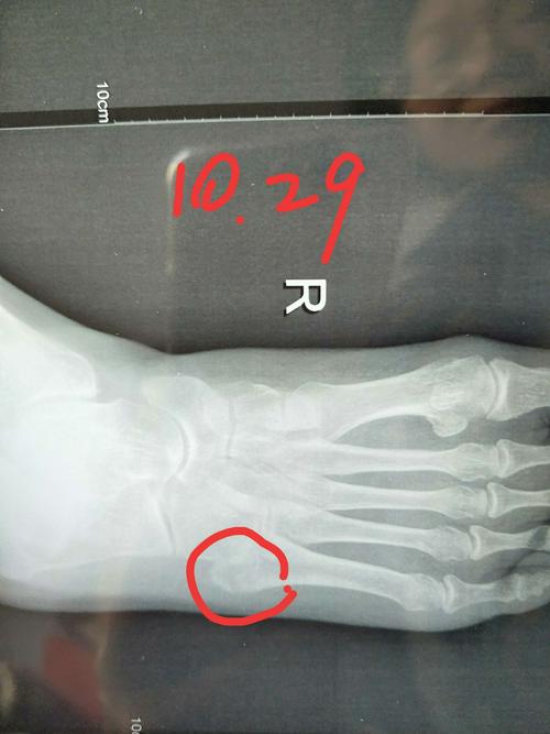 右脚第五跖骨基底骨折康复记