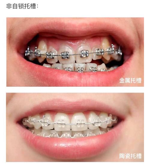 牙套矫正,半隐形牙套,陶瓷牙套_牙膏什么牌子好_牙套