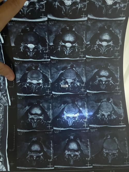 8号问了当医生的表弟说应该是腰椎间盘突出,最好去拍个ct或者核磁共振