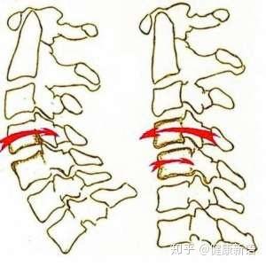 腰椎小关节紊乱
