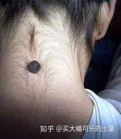 当你的痣有以下几个症状时就要注意了!可能是癌变!