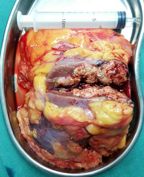 剖开标本见肿瘤剖面呈鱼肉状,符合肾透明细胞癌表现.