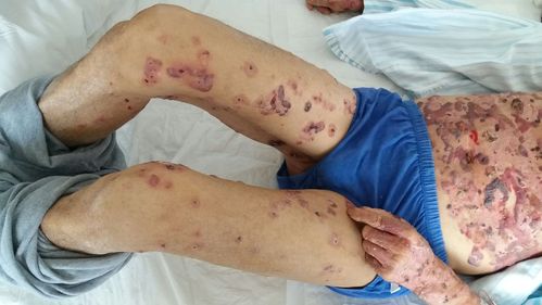 大疱性类天疱疮