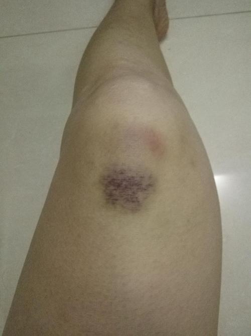 膝盖淤青一块块,往日白白嫩嫩的大腿也粗糙泛青了.