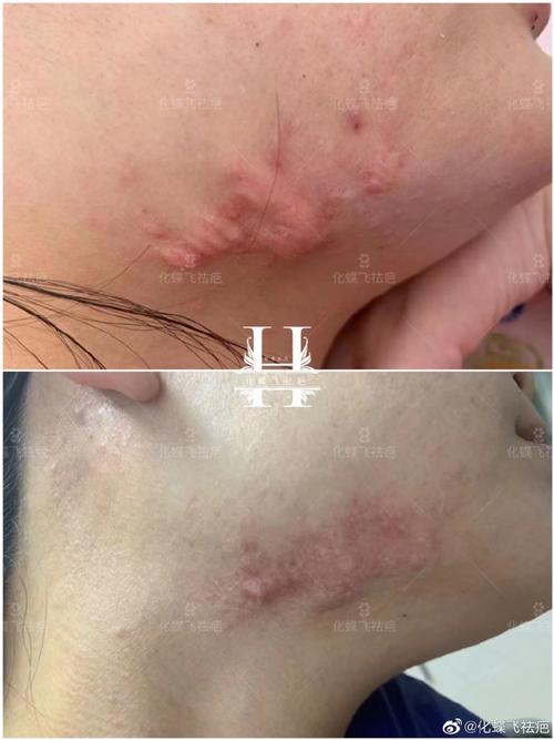 化蝶飞祛疤##疤痕修复##祛疤