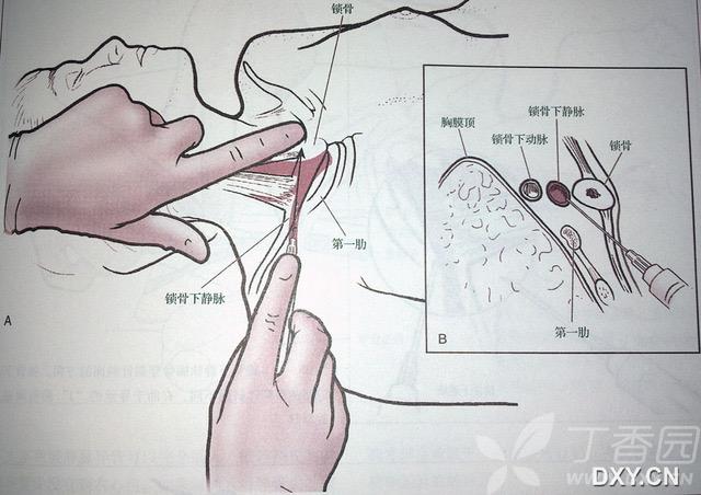 锁骨下静脉及颈静脉穿刺